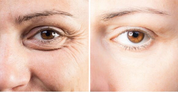 A Comprehensive Guide to Reduce Wrinkles